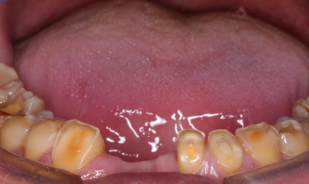 内倾型深覆19伴牙齿过度磨耗的咬合重建∣绚彩梦想秀 全国10强 病例