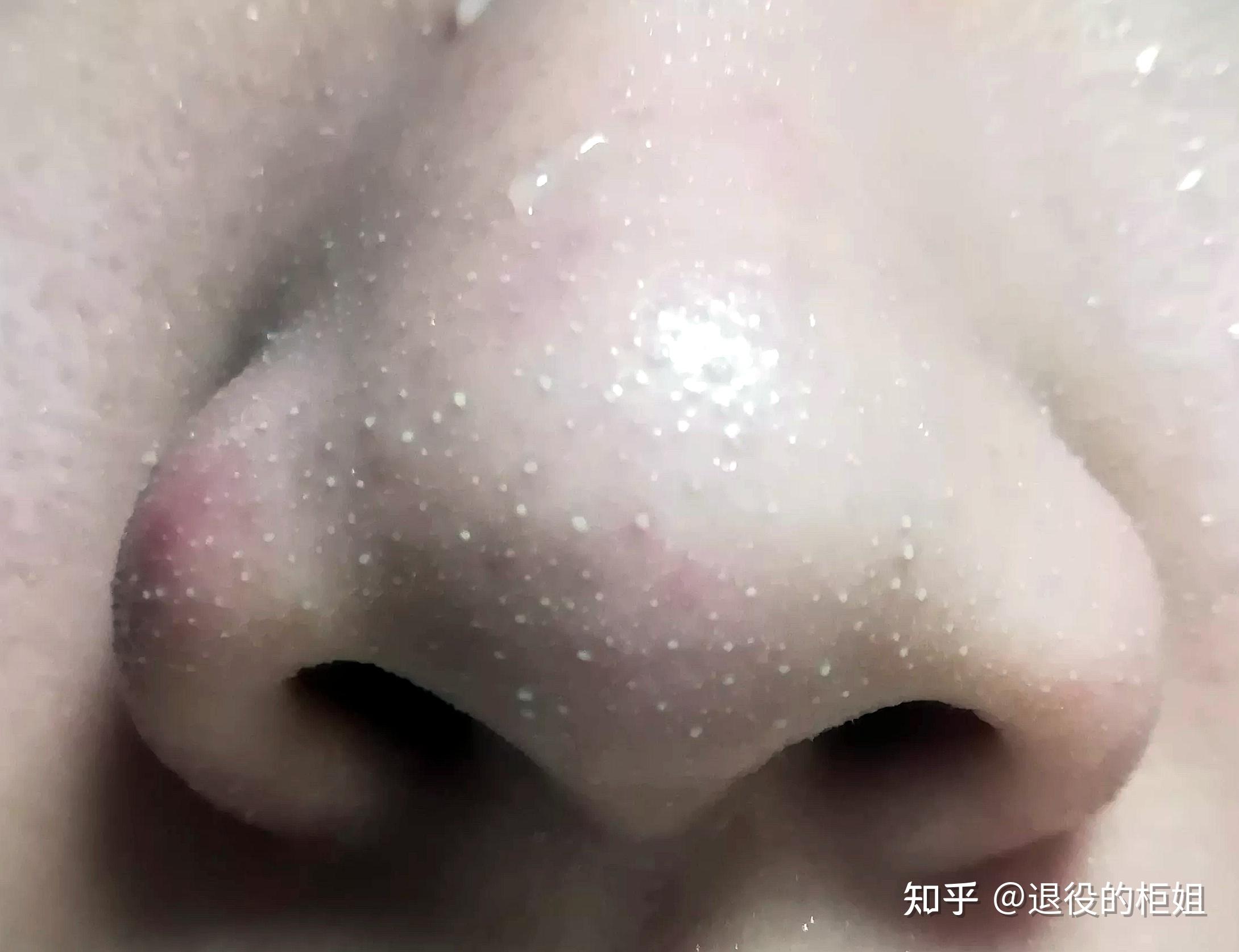 鼻子上挤出来一条条白色的东西到底是什么?