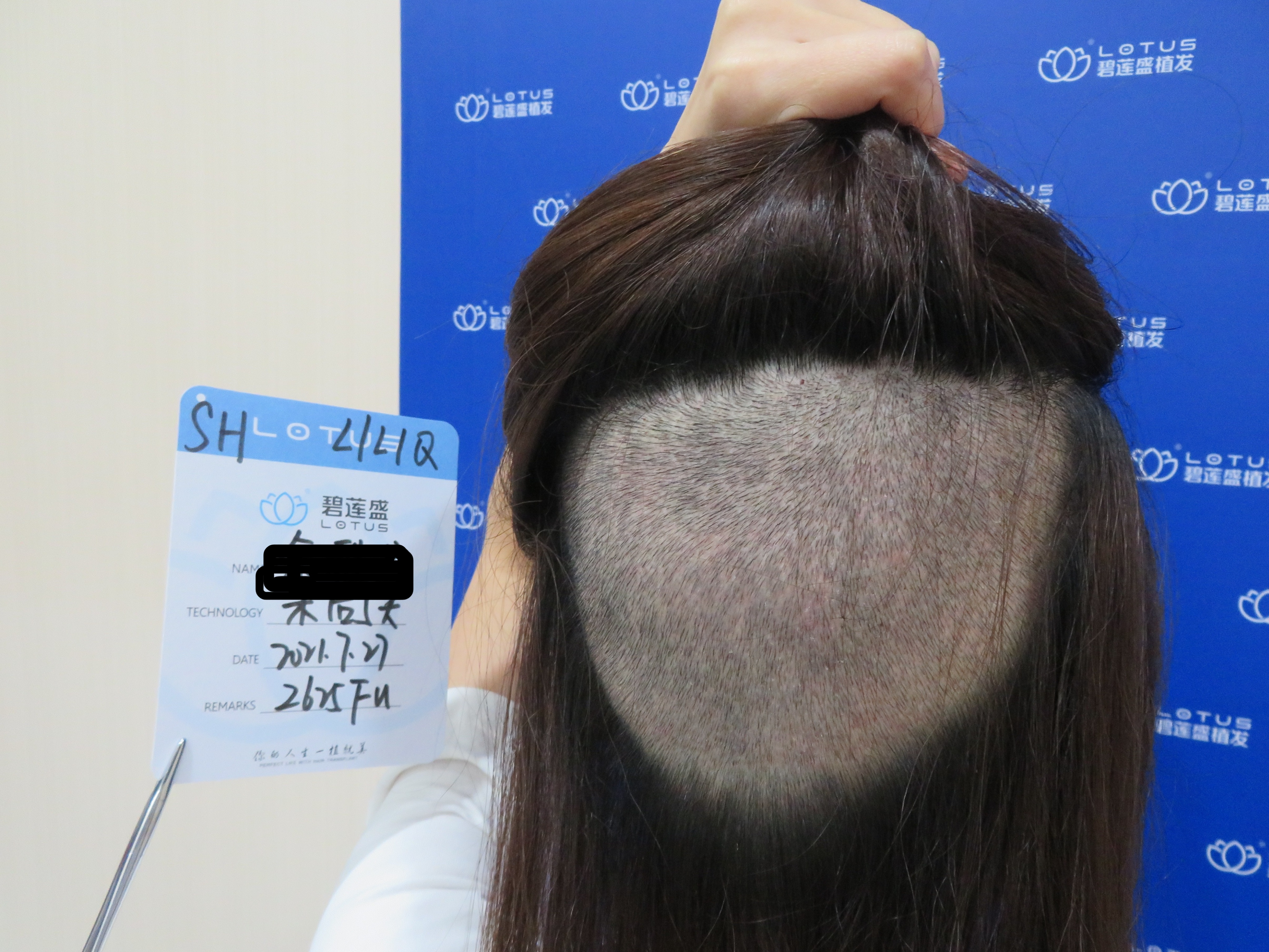 孕后植发(植发对生孩子有影响吗)