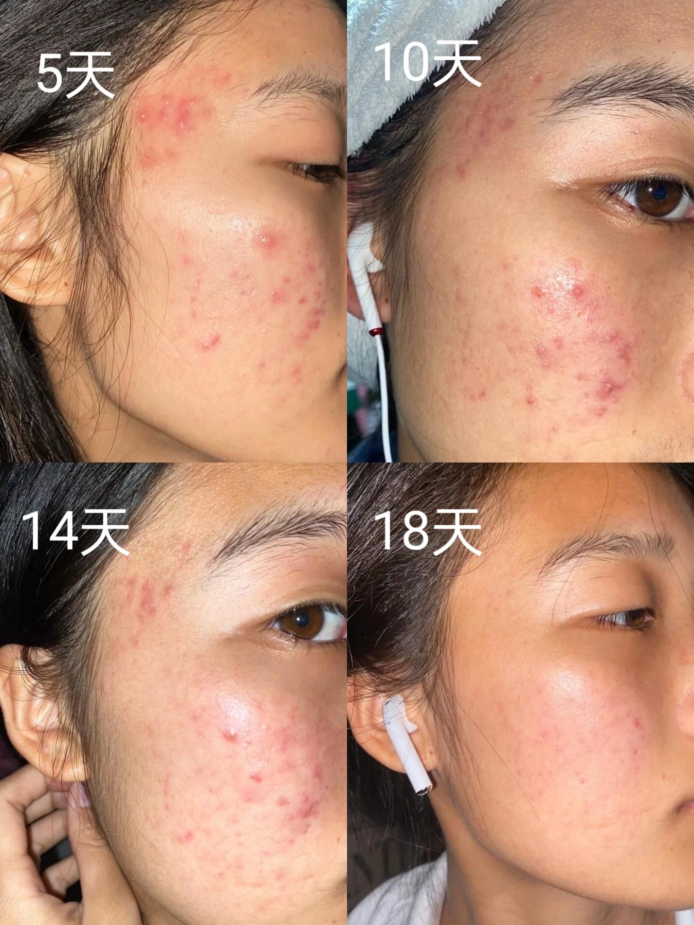 額頭 皮膚 敏感 (96) 사진