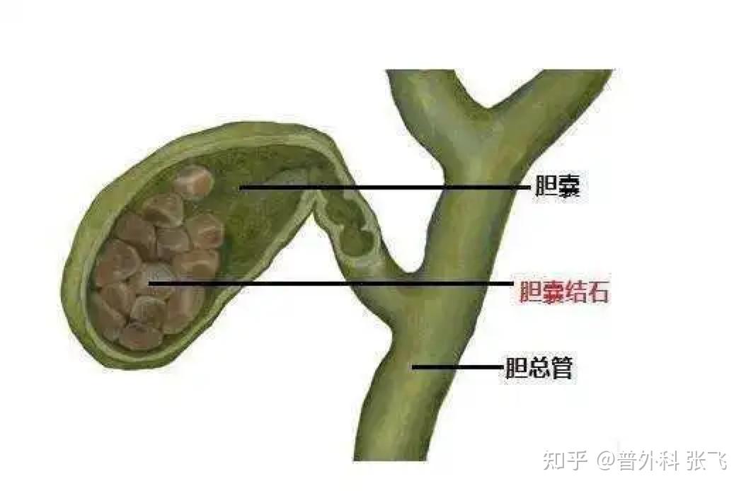 肥胖與糖尿病等;(3)具有膽囊癌危險因素,如膽囊萎縮,充滿型結石,瓷化