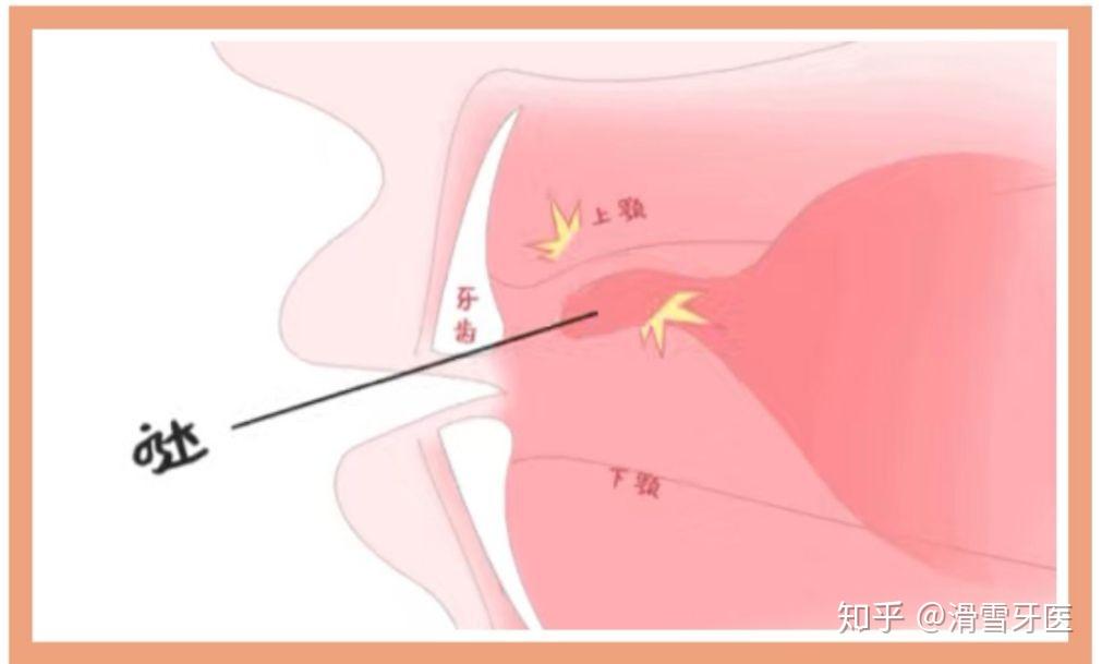 你们平时舌头是怎么放在嘴里的? 