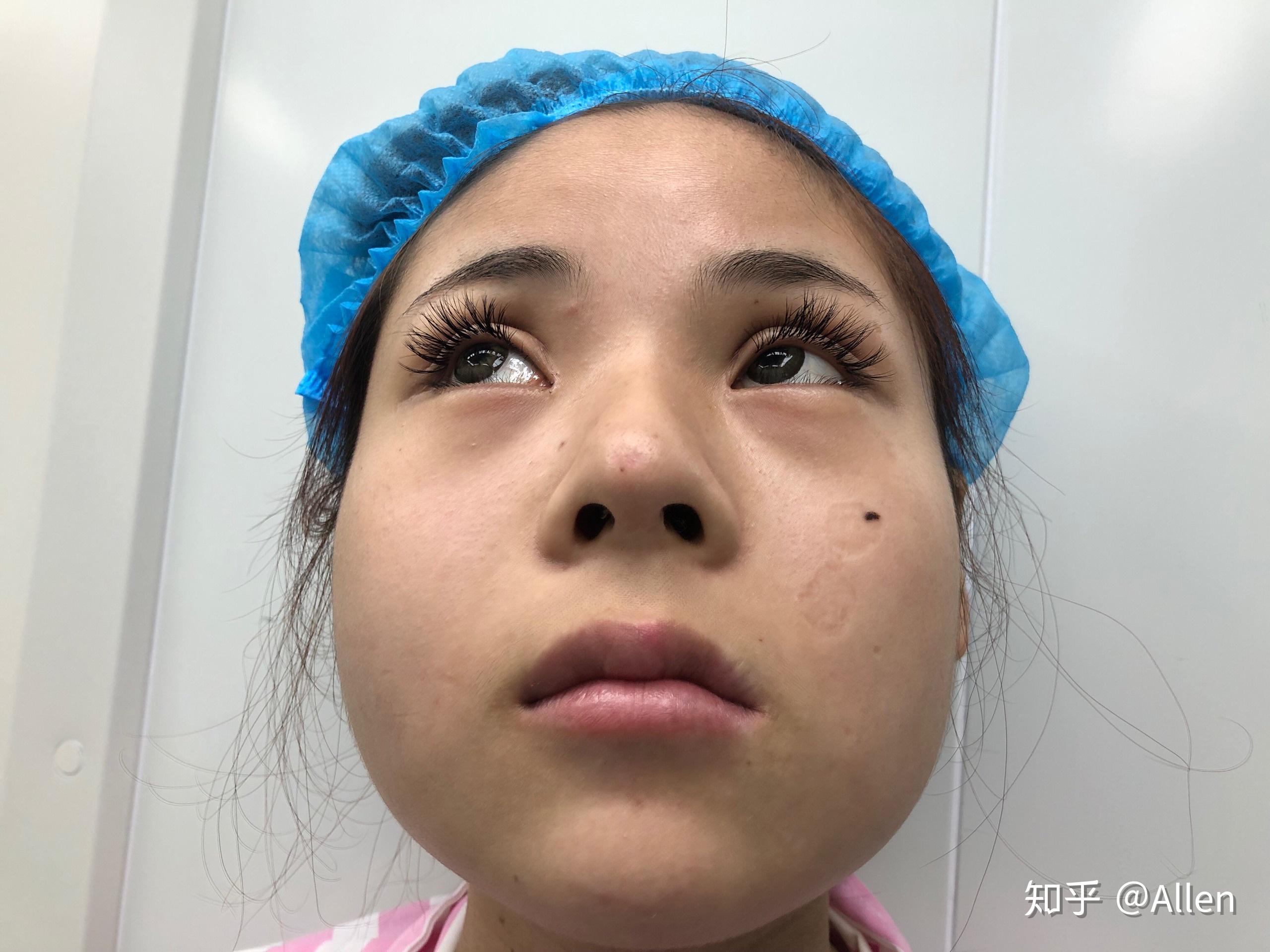 杭州隆鼻 | 为什么有些人鼻子做完手术之后会发生挛缩变形？ - 哔哩哔哩