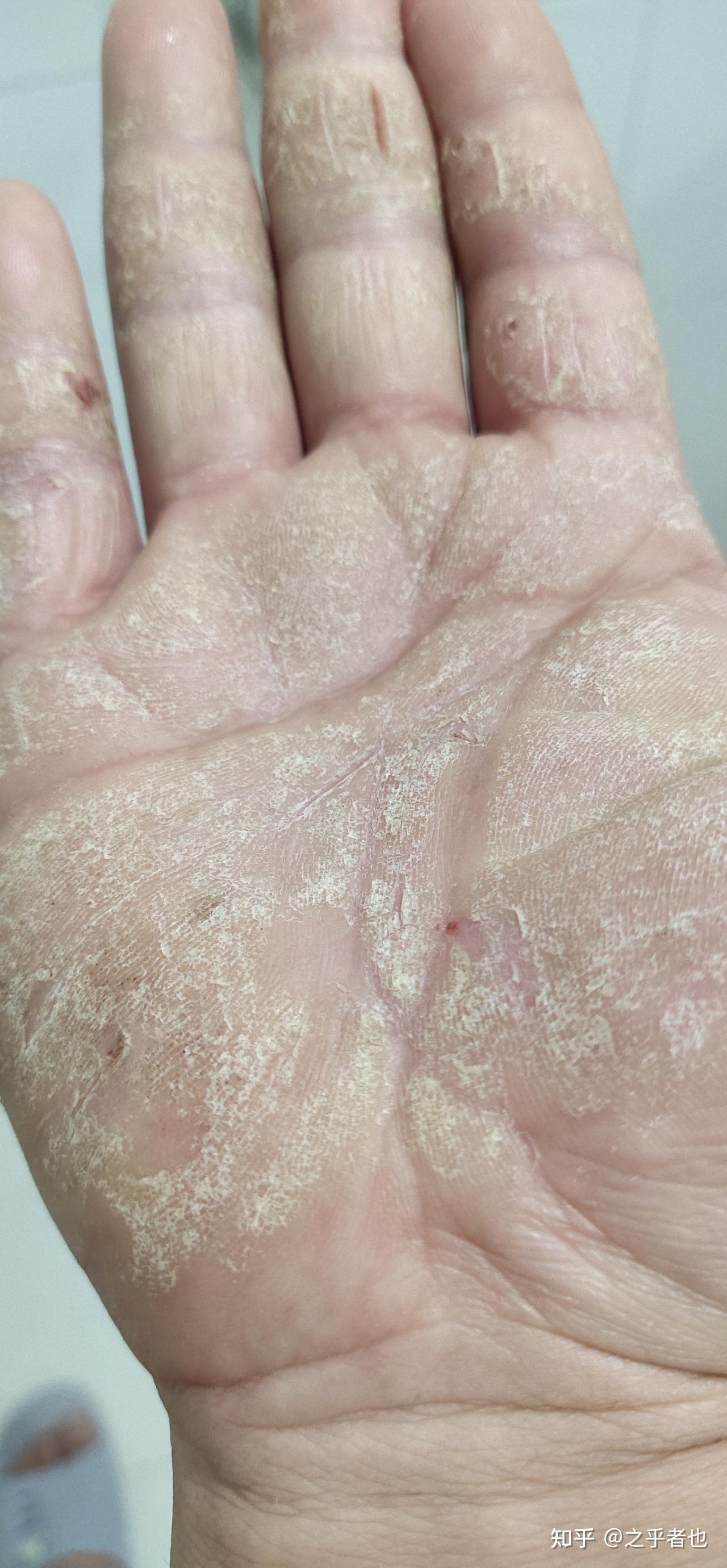 手足慢性湿疹的痛苦
