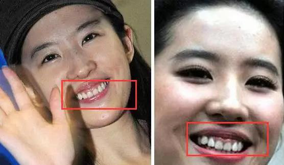 让人畏惧的"颜值杀手"深覆合还有救吗?