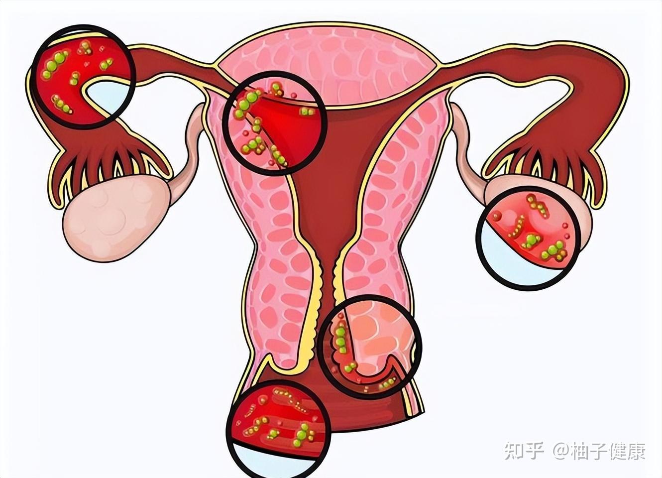 hpv病毒不仅仅是女性才会感染,男性同样也会感染,只是感染的概率比