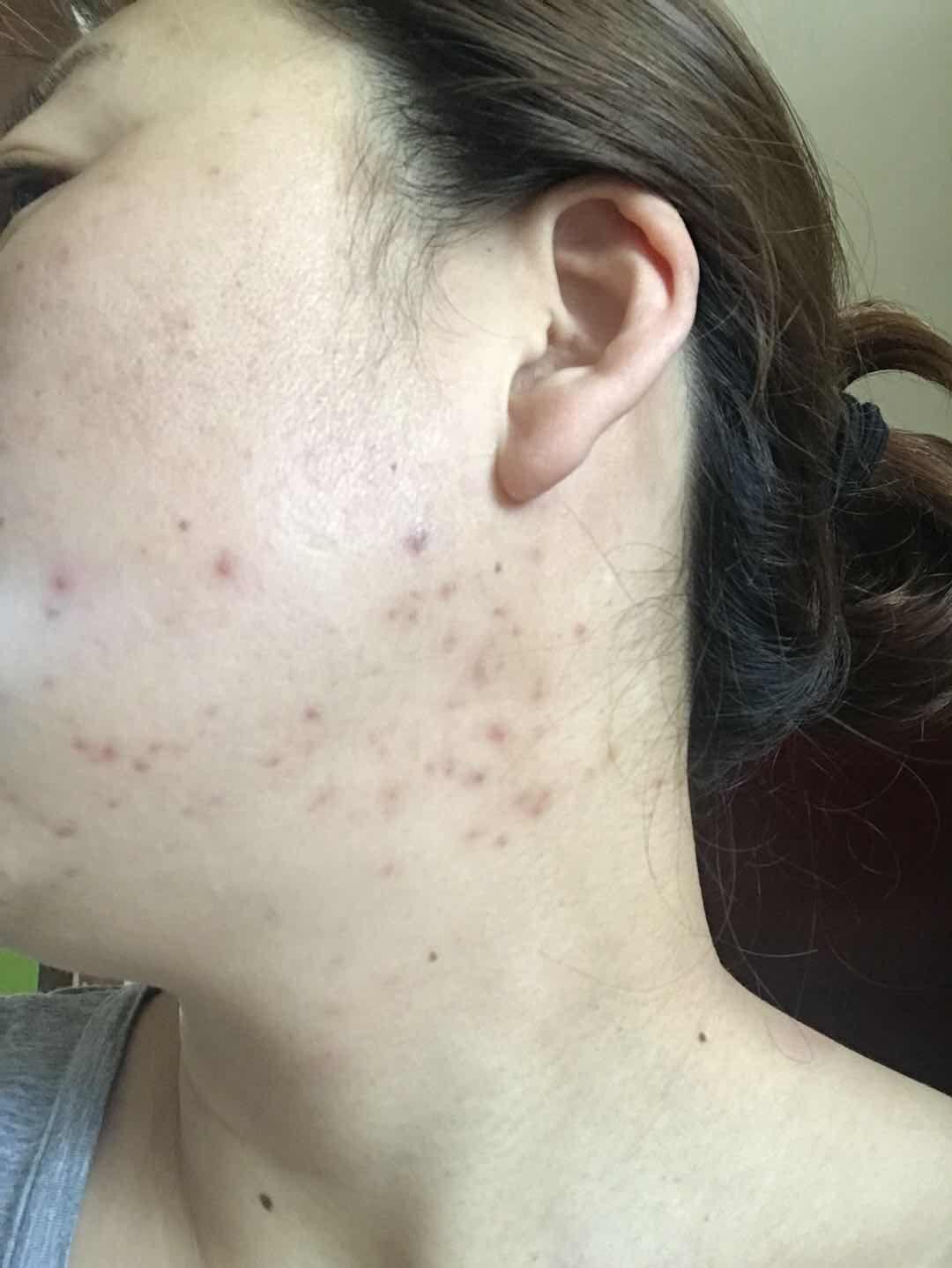 面部痘痘长在不同的部位能否反应健康问题，如果可以，是怎样的健康问题？