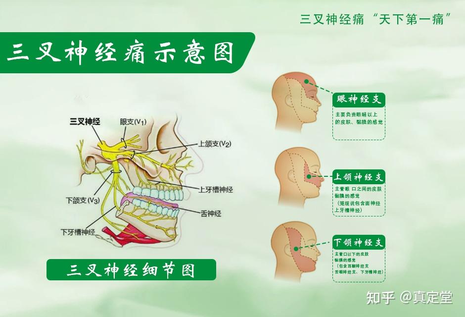 三叉神经炎与三叉神经痛 - 知乎