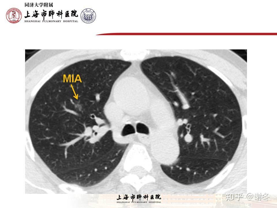 表現為磨玻璃結節磨玻璃影的微浸潤腺癌mia