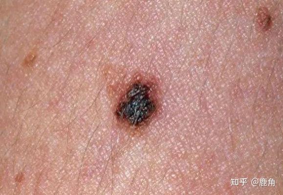一,黑色素瘤的症状黑色素瘤是一种源于黑色素细胞的恶性肿瘤,常见于