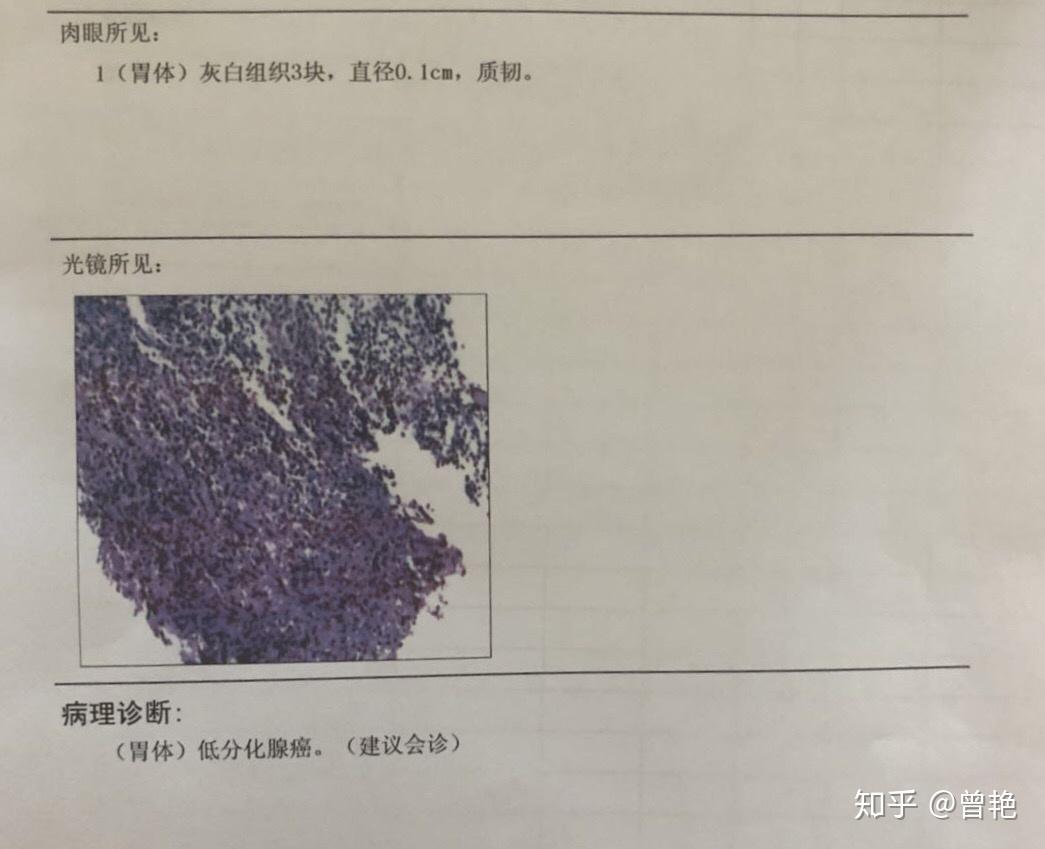 抗癌日记胃癌低分化腺癌印戒细胞癌