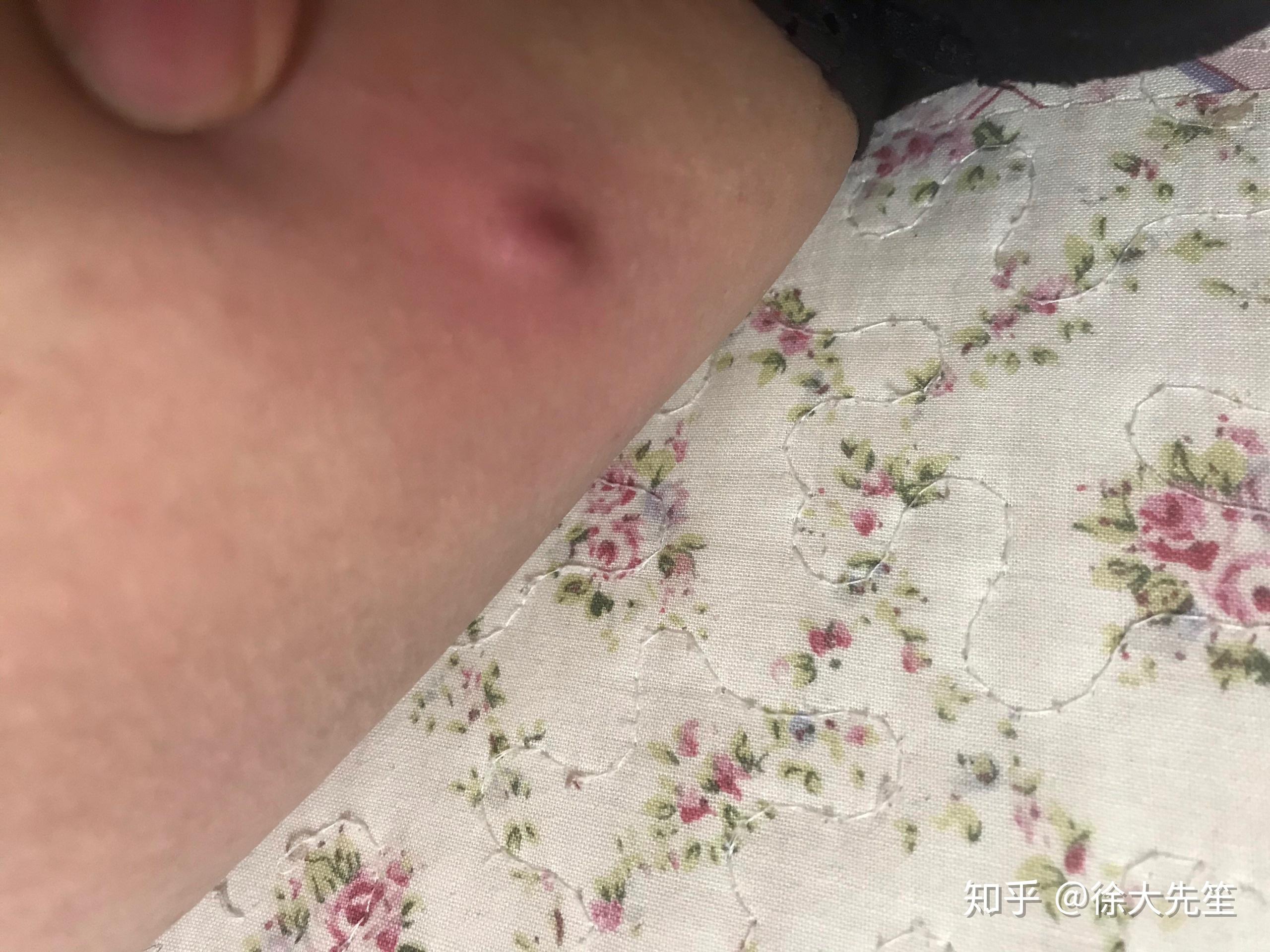 大腿根部长的肉疙瘩