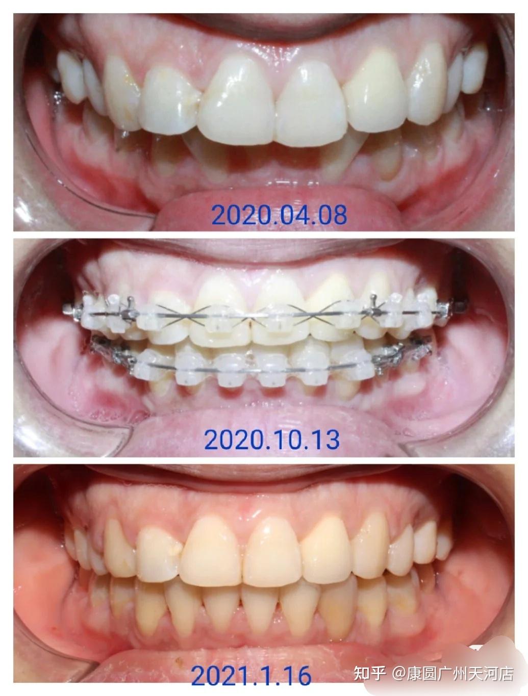 牙齿矫正案例分享覆盖大不齐