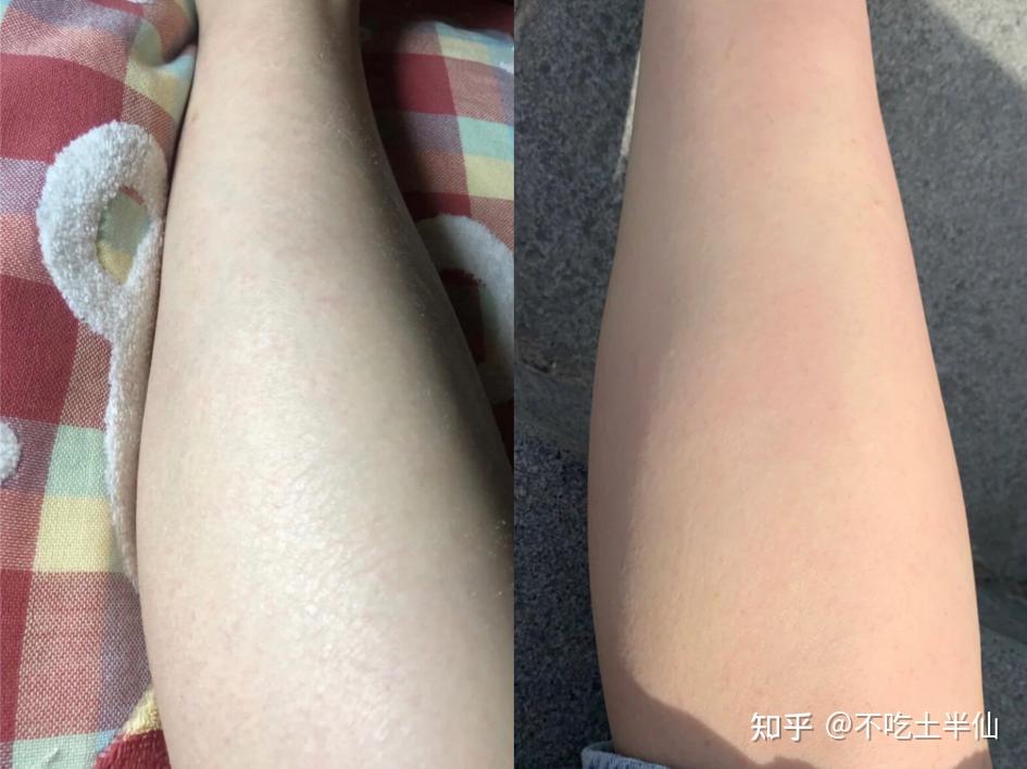 女生用什么脱毛膏比较靠谱鸡皮怎么去