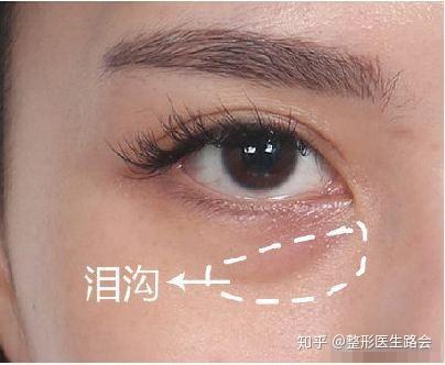 玻尿酸填充泪沟淤青不退自体脂肪填充会不会更好更安全