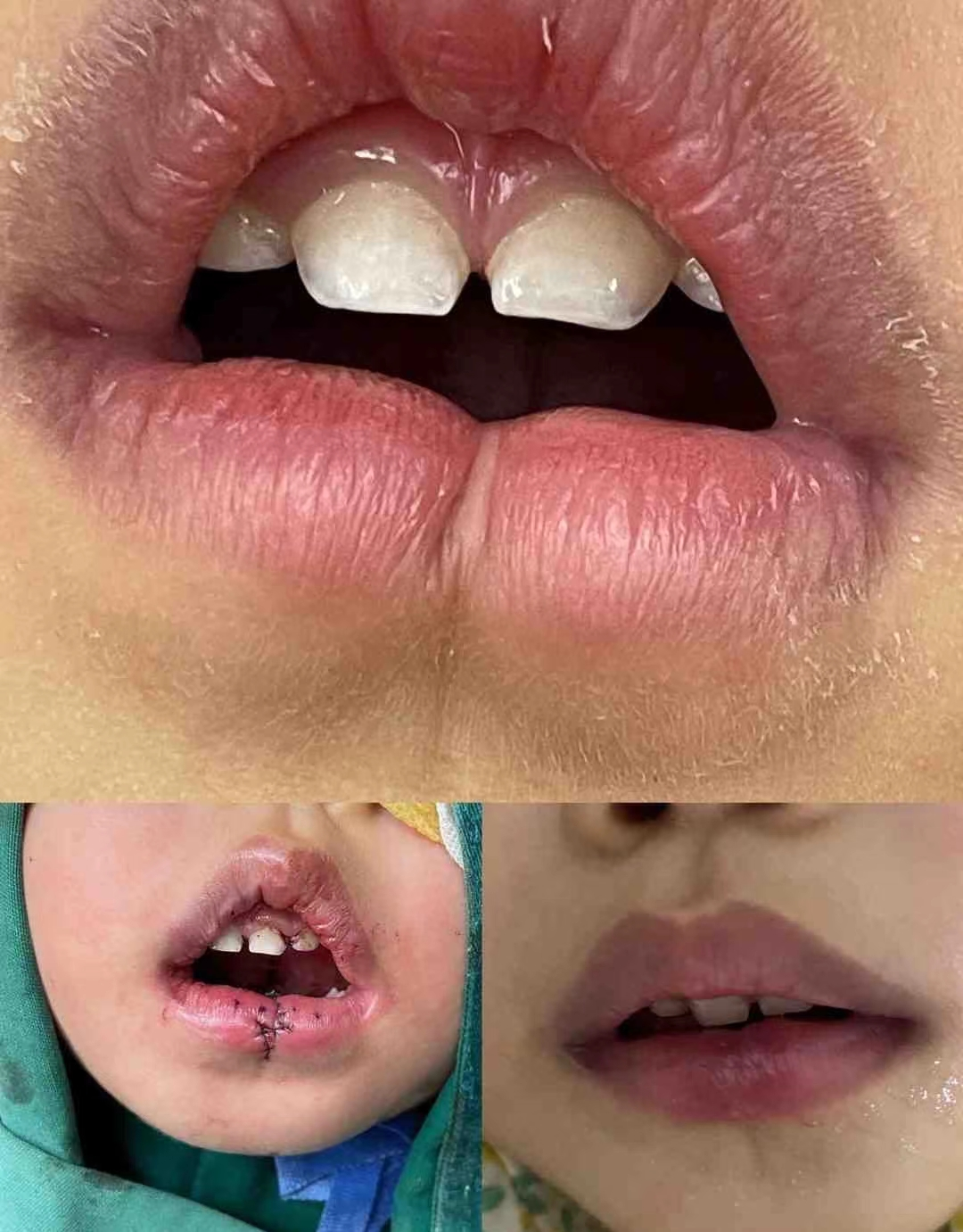 我也是成都本地的,真心觉得唇腭裂患者挺难的