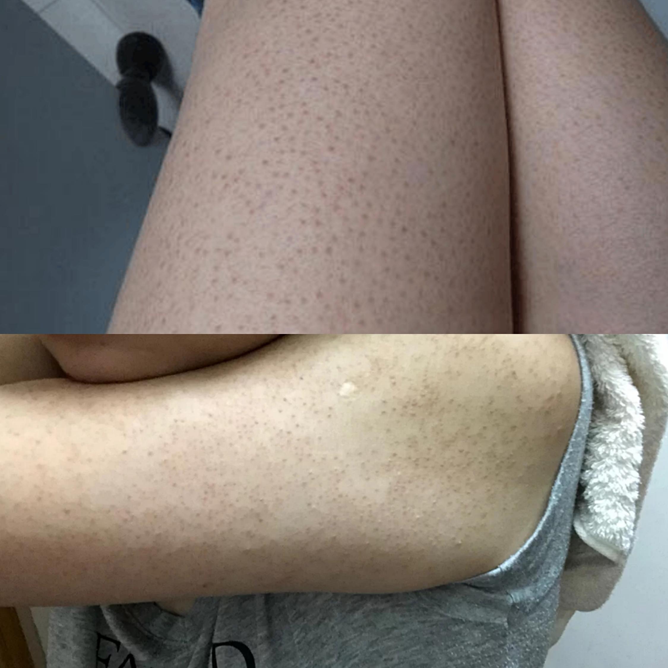 鸡皮肤需要去治疗吗(鸡皮肤没有办法治疗吗)