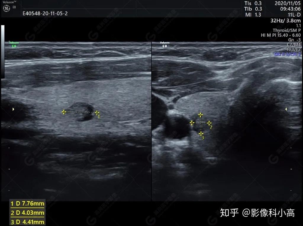【高尚超声】浅表病例之结节性甲状腺肿 