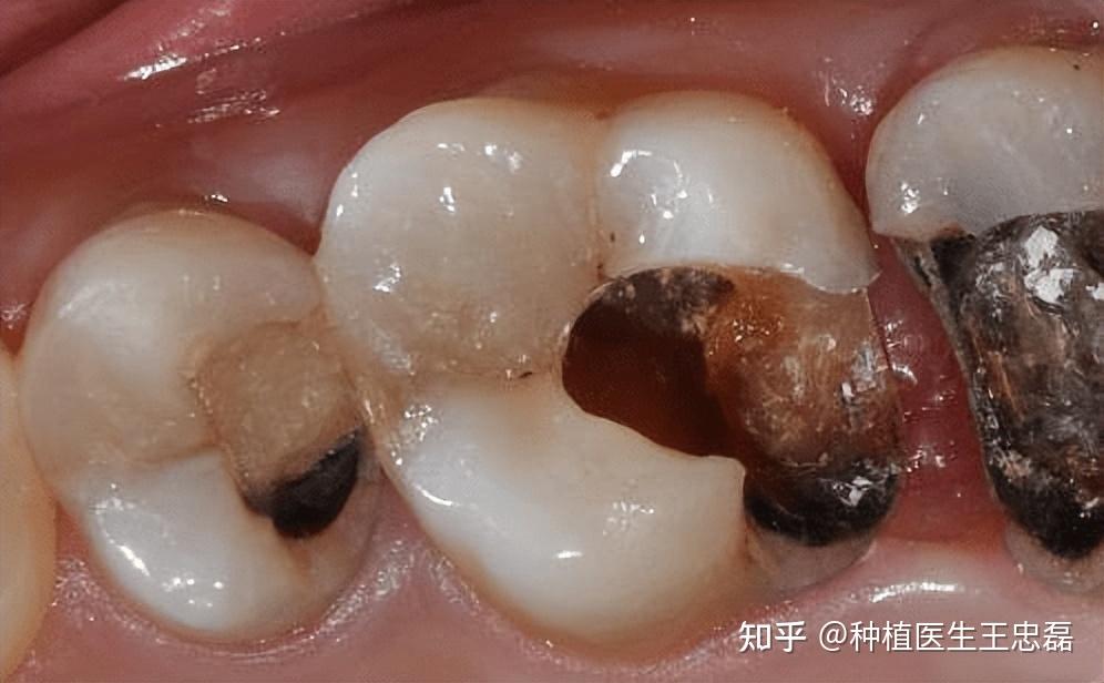 在日常饮食时,食物容易嵌塞进牙洞,导致细菌不断滋生,牙齿嚼丛嚼玫