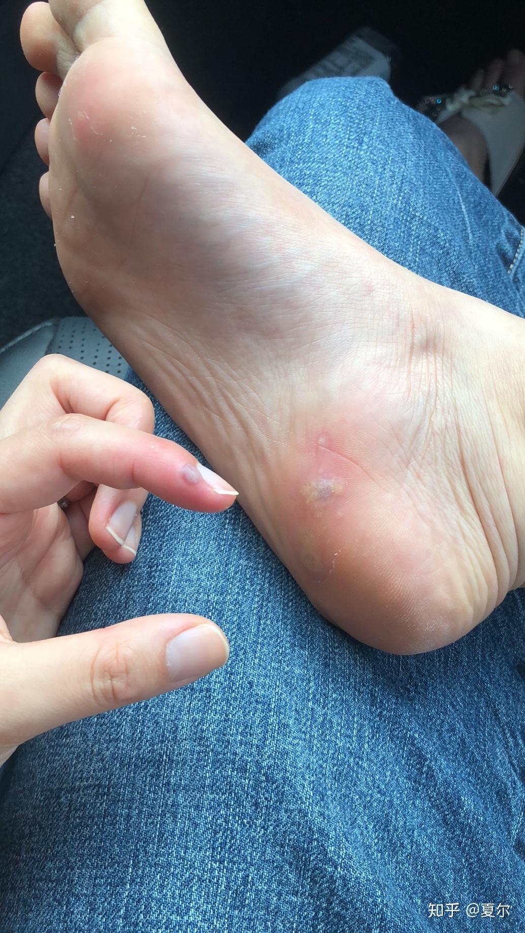 20五一记录冷冻跖疣