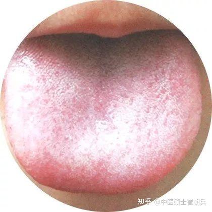 史上最全高清舌诊图谱,堪比教科书(收藏篇) - 知乎