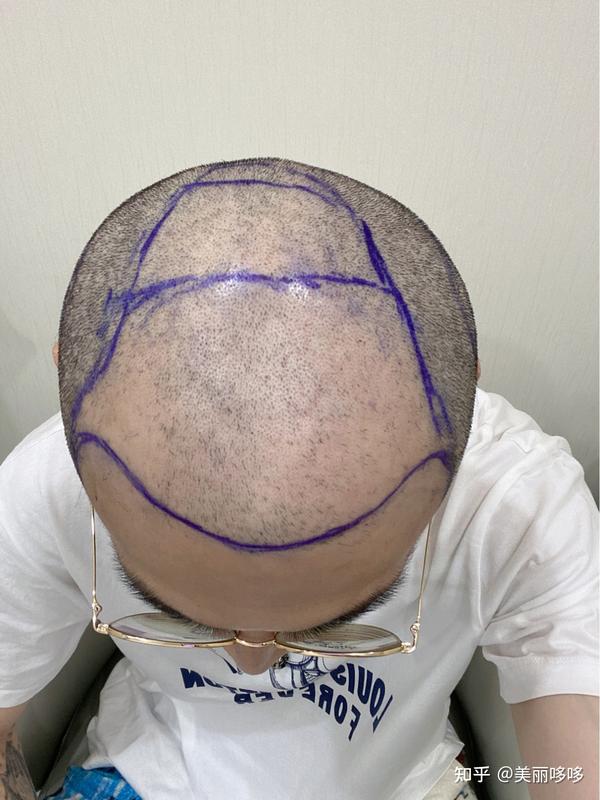 植发4500单位前后对比,分享我的植发经历