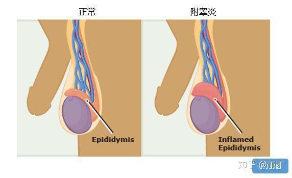 蛋蛋疼痛之 附睾炎 知乎