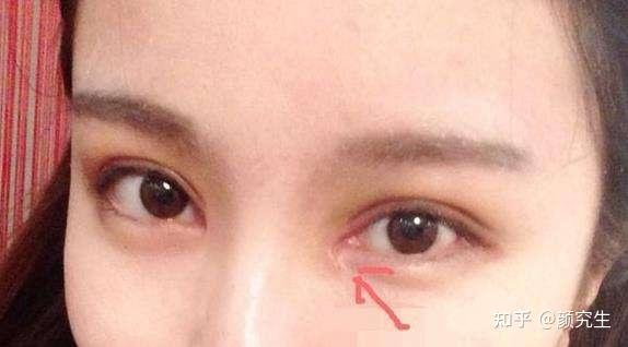 做开内眼角手术受不受年龄的限制？ - 知乎