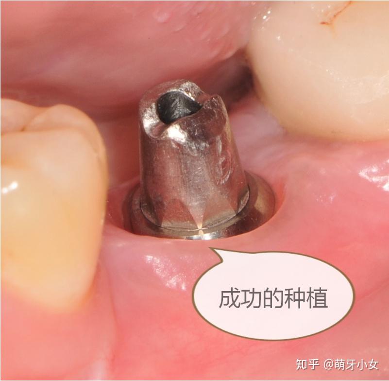 9个步骤带你了解种植牙全过程