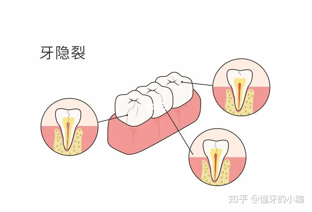 走进牙隐裂 - 知乎