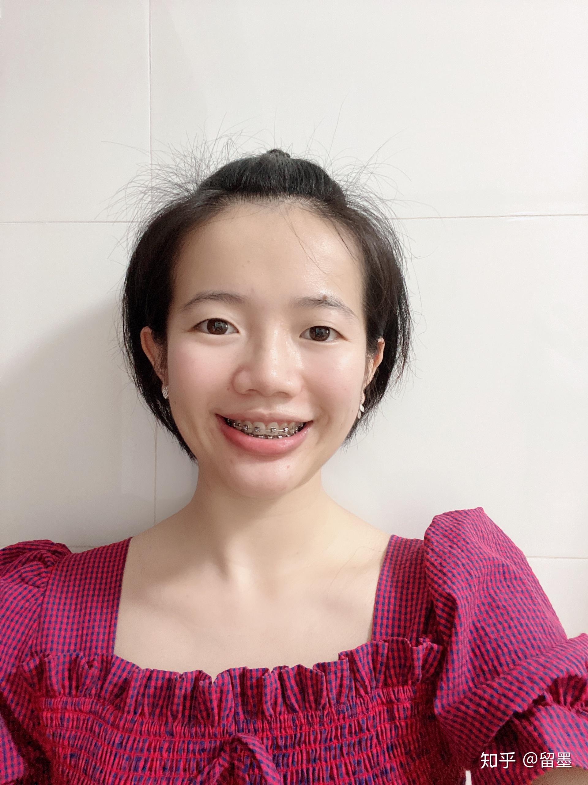 24岁深漂女青年箍牙全记录