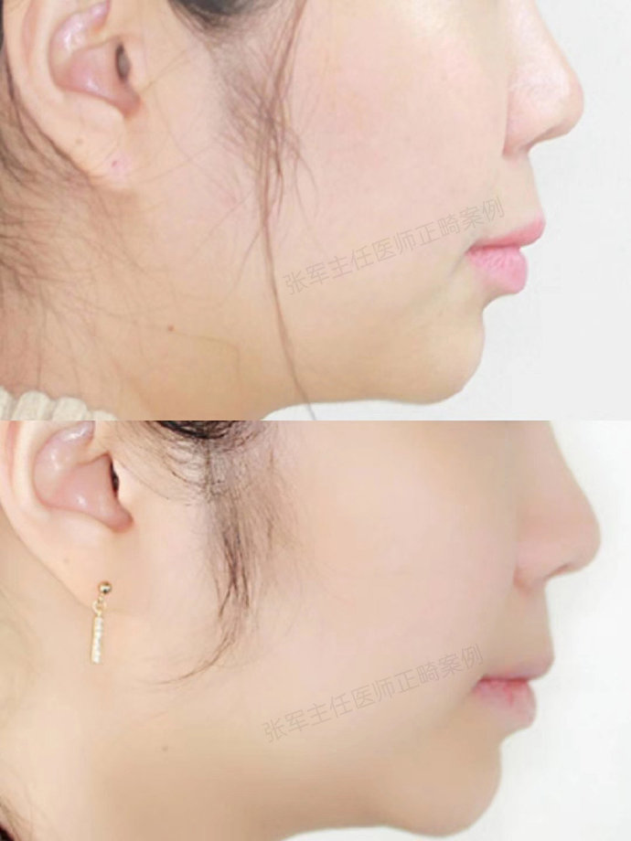 目前到了矫正后期,姑娘对自己的侧貌的改变也表示很满意,接下来继续