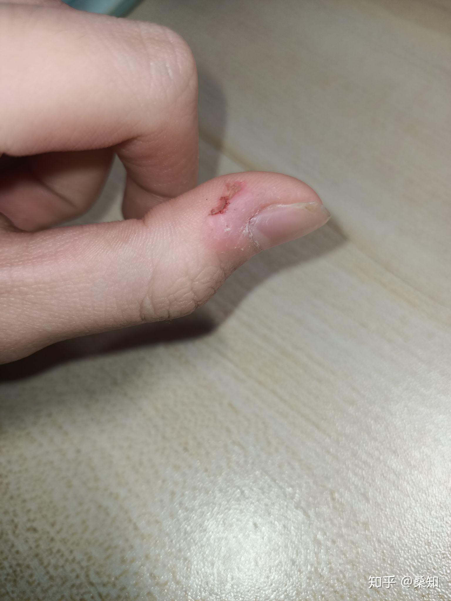 如何控制不自觉的没完没了的撕手皮如何恢复手指皮肤的状态比如已经撕