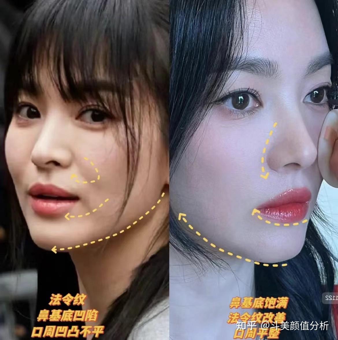 普通人如何安全高效的消除脸上的“三八纹”?法令纹/鼻唇沟、木偶纹/嘴角纹全都有我该怎么办? - 知乎