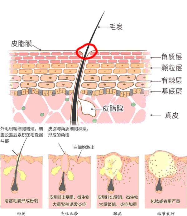 毛囊里的皮脂腺分泌物无法正常排出,就慢慢形成了闭口皮肤在这样一个