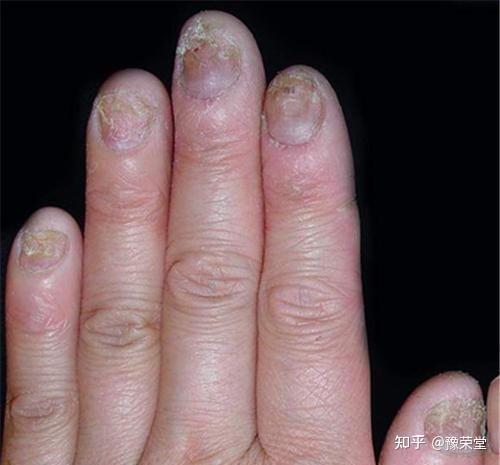 灰指甲的艰辛治疗!