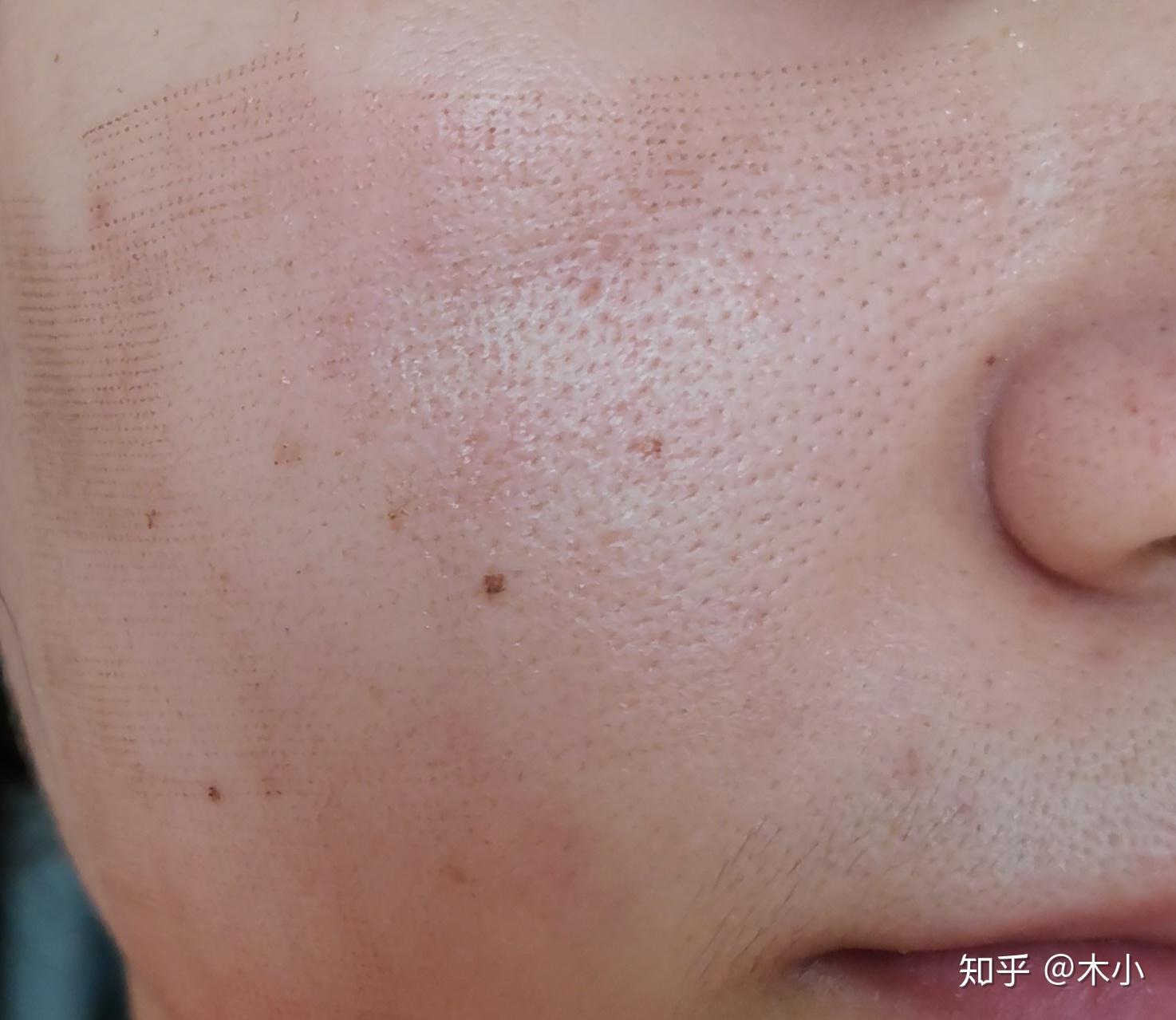 记录一下点阵激光收缩毛孔全过程