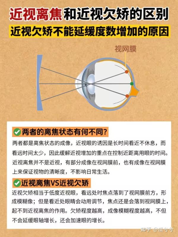 近视离焦 - 知乎