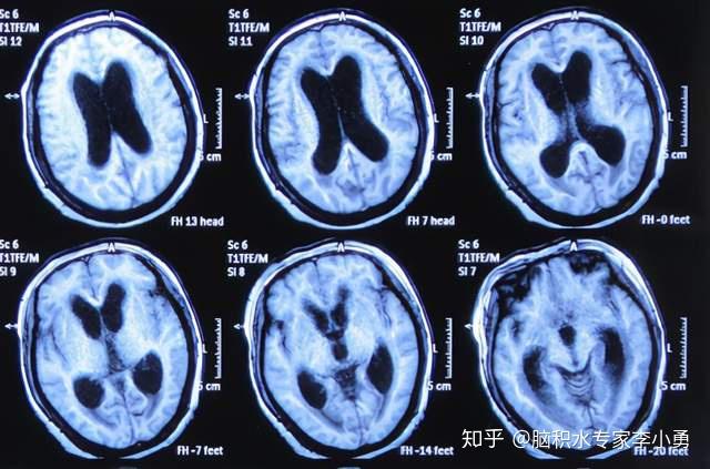 經鼻蝶垂體瘤術後腦脊液鼻漏和顱內感染併發症性腦積水及腦積水分流