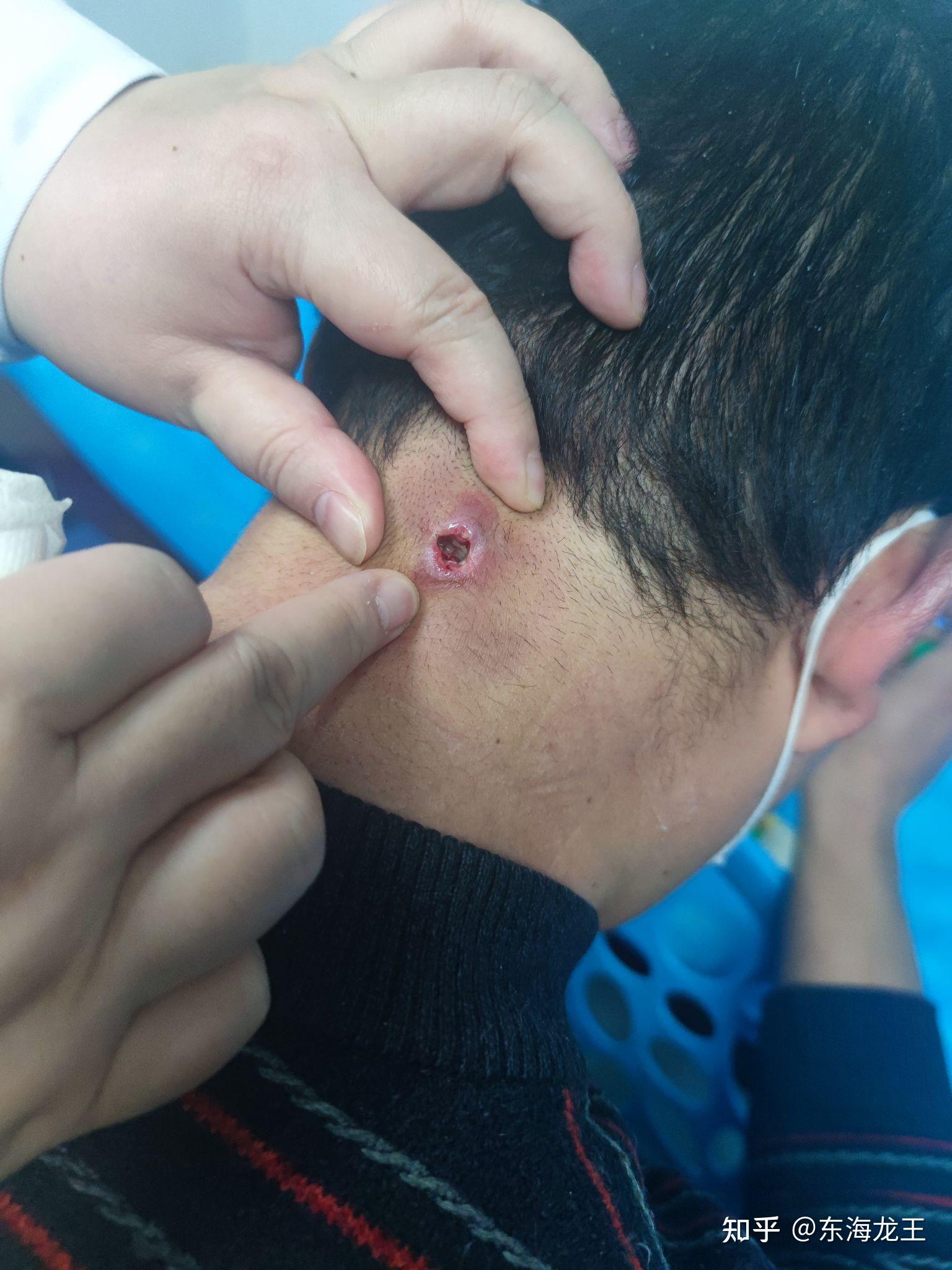 一次得痈的经历.