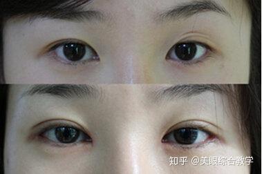 什么是双眼皮褶皱 v2-27196824d8f227da6346decbb032ae2d_b.jpg