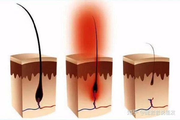 毛囊逐漸萎縮,變小,終於被毳毛所代替,最後許多毳毛,毛囊消失,毛囊
