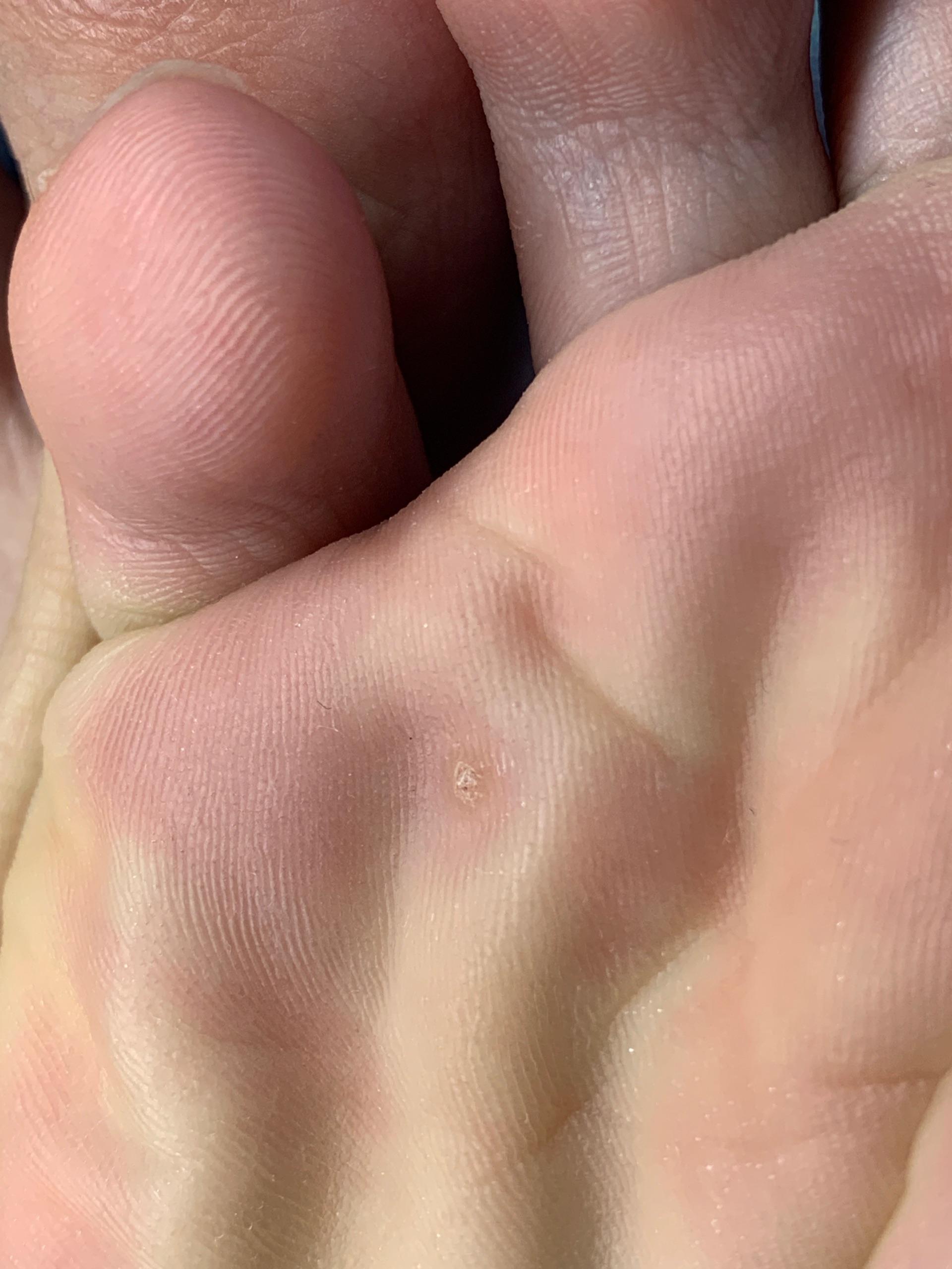 冷冻跖疣过程记录