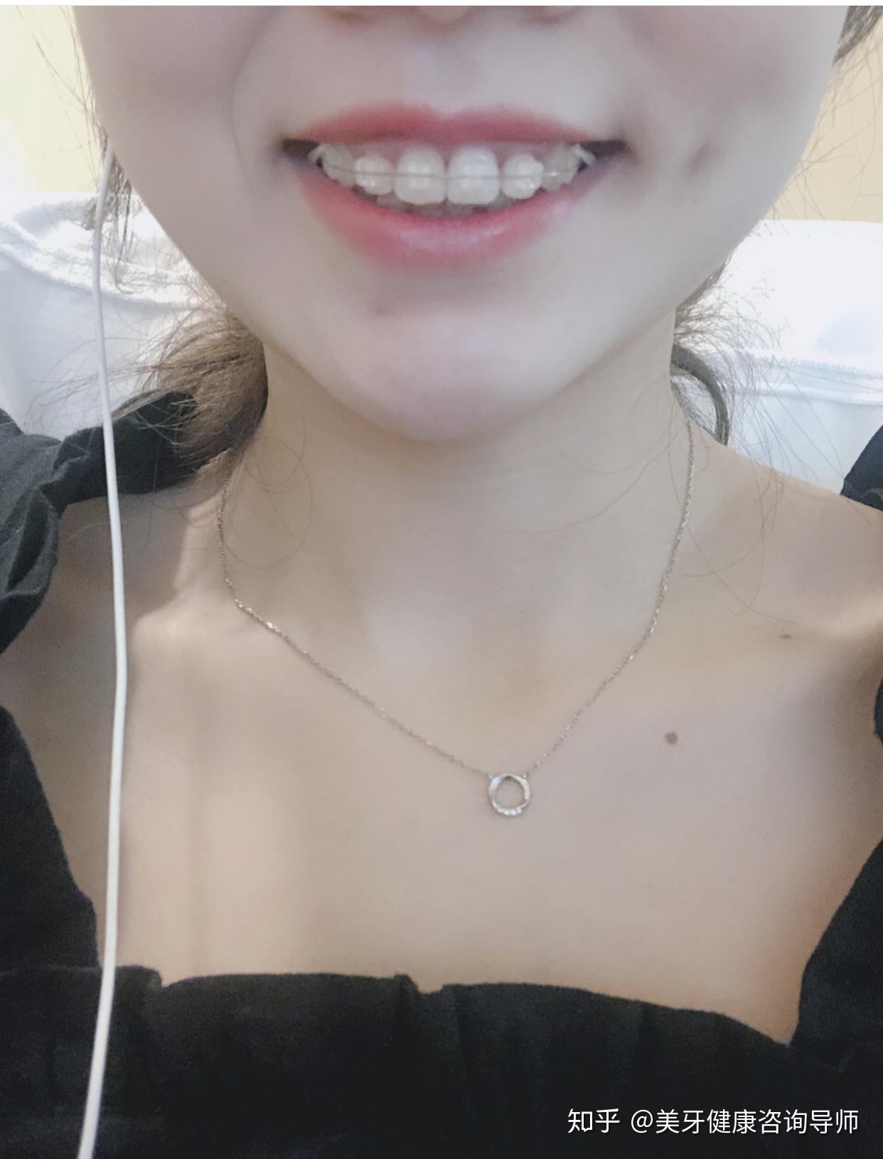 冰晶半隐形矫正在无形中悄悄的变美