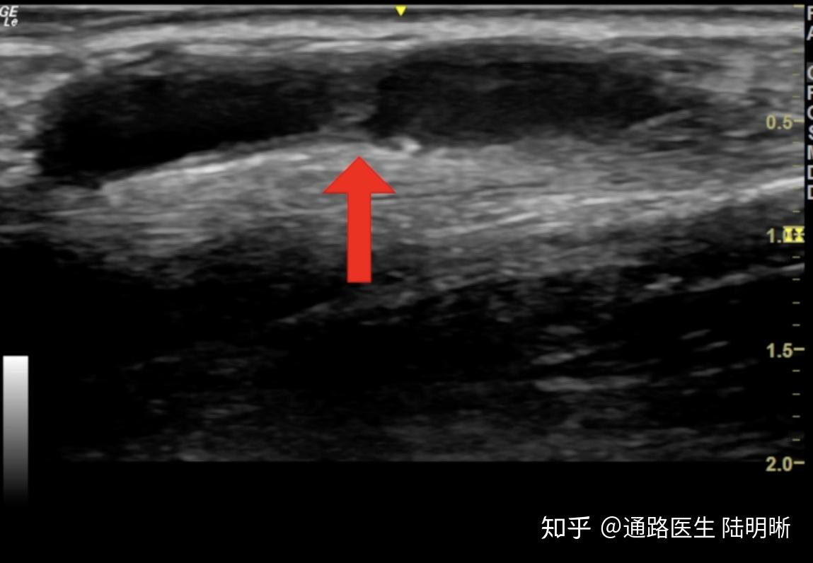 隔瓣型狭窄PTA导丝进入夹层 - 知乎