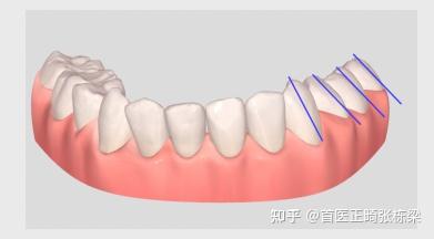 偏颌牙齿正畸方案思路,脸歪大小脸必看! - 知乎
