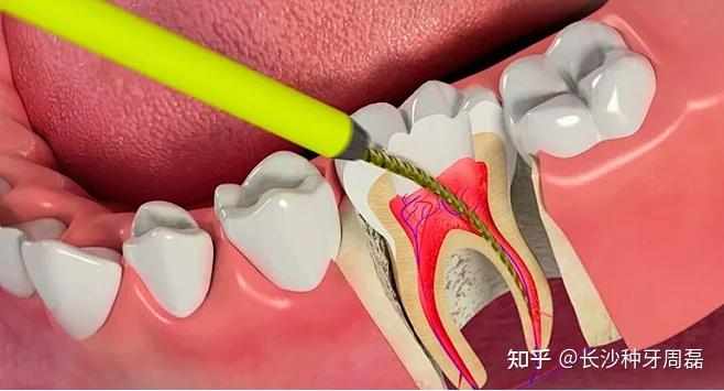 根管治疗过的牙齿后面还能做种植牙吗? - 知乎