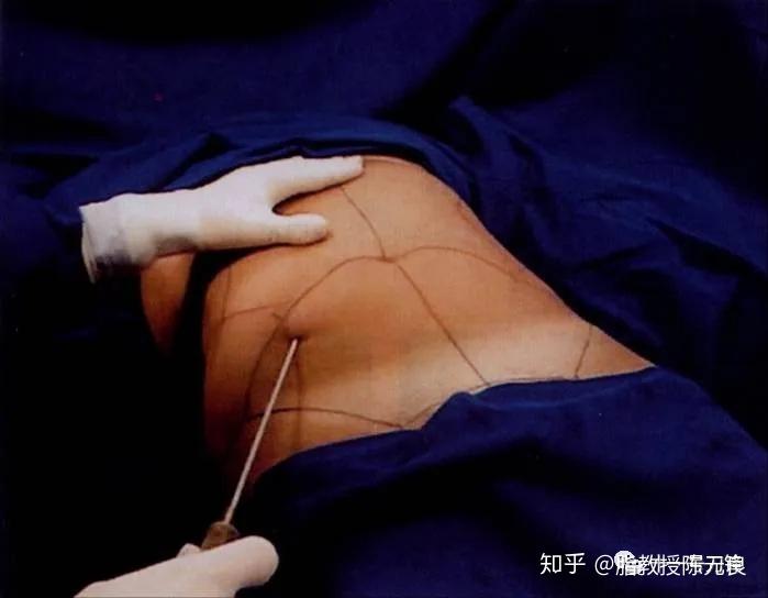 肚脐整形手术效果图图片