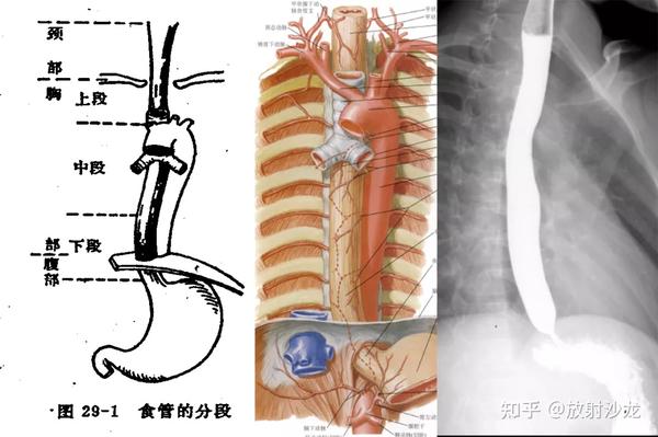 通过病例,一起来学习食管影像解剖和非肿瘤性病变 - 知乎