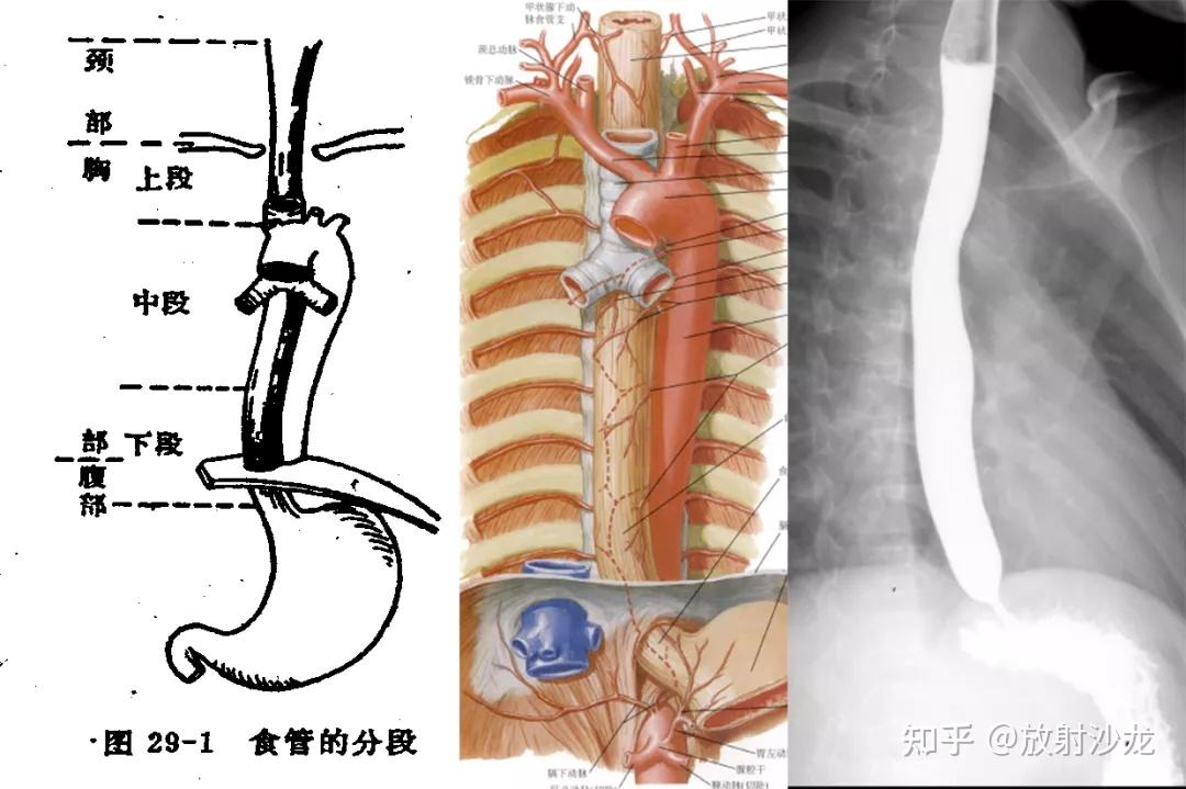 通过病例,一起来学习食管影像解剖和非肿瘤性病变 - 知乎